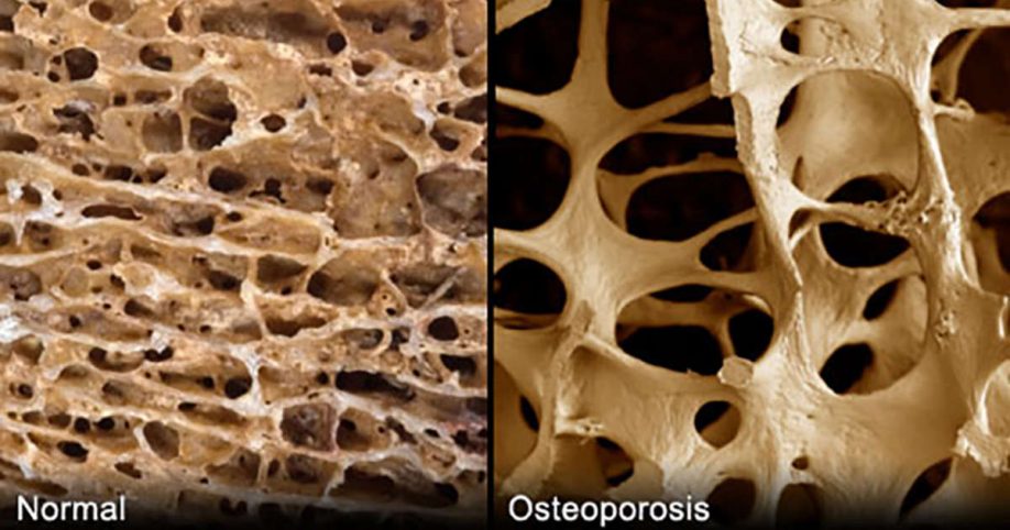 cause-of-osteoporosis